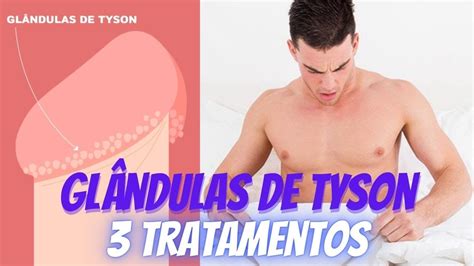 glandulas tyson o que é|Glândulas de Tyson: o que são, porque aparecem e tratamento